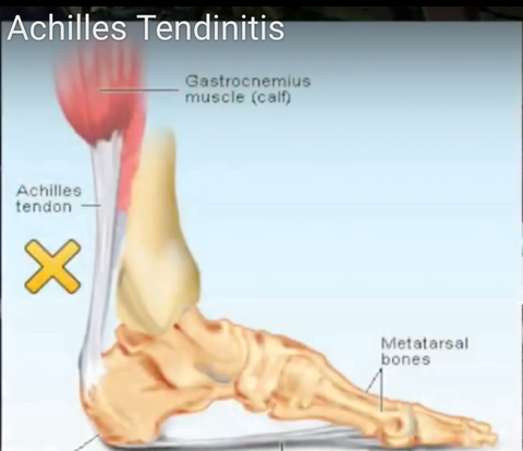 How to Deal with Achilles Tendonitis